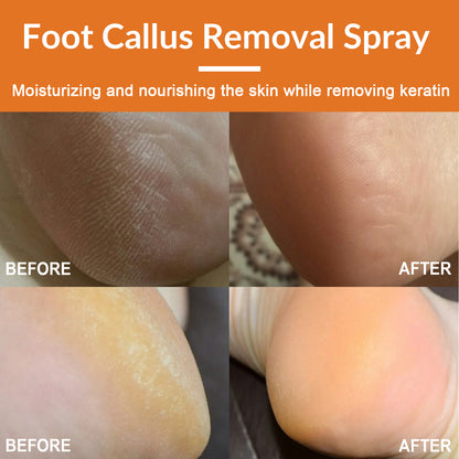 South Moon Foot Exfoliating Spray Gently Calluses Remove Dead Skin Cleansing Repair Rough Calluses